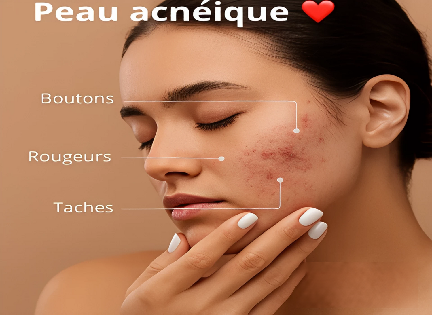 Peau Acnéique